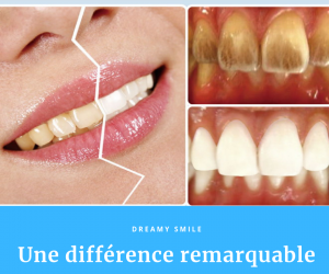 Blanchiment des dents avec Dreamy Smile