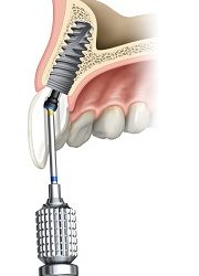Comment choisir une marque d’implants dentaires ?